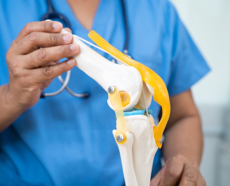 Osteoarthritis of the knee, Doctor holding human knee joint orthopedic anatomy model in hospital.